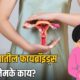 Uterine Fibroids Symptoms